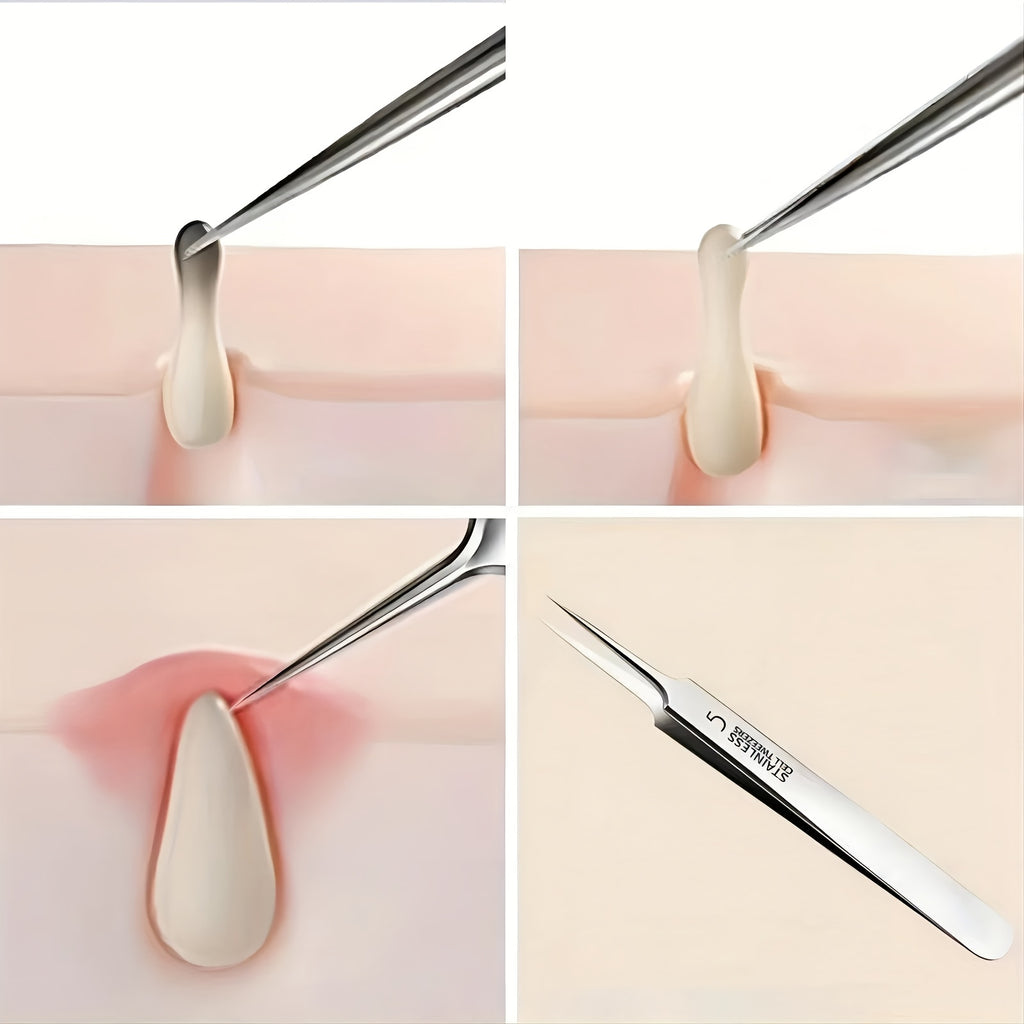 1 Pack Extra Fine No. 5 Blackhead Tweezers - Facial Beauty Remove